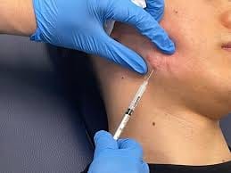 Intralesional Steroid Injection For Keloid