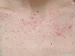 Steroid Acne